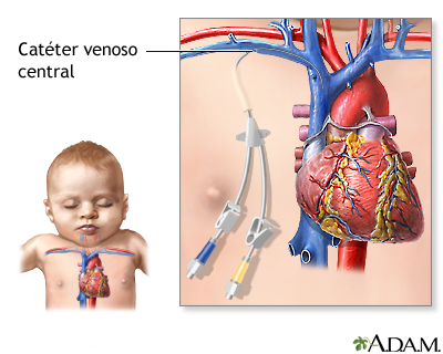 Catéter venoso central