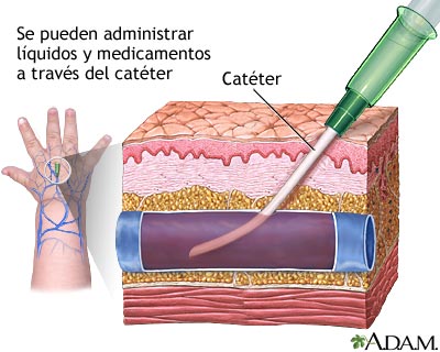 Vía intravenosa periférica