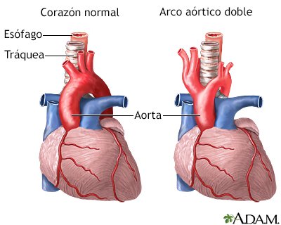 Arco aórtico doble