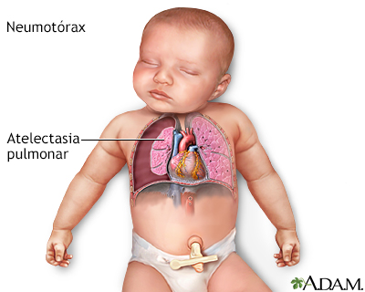 Pneumothorax