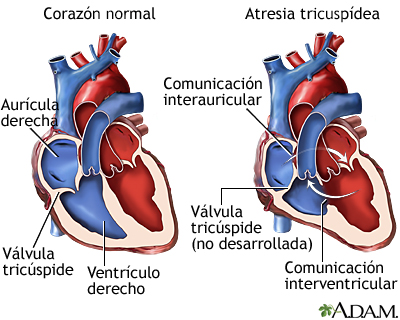 Atresia tricuspídea