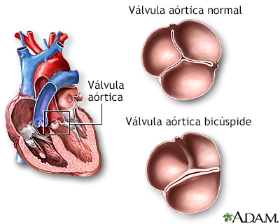 Válvula aórtica bicúspide