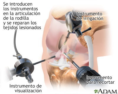 Artroscopia de rodilla