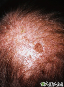 Queratosis actínica en el cuero cabelludo