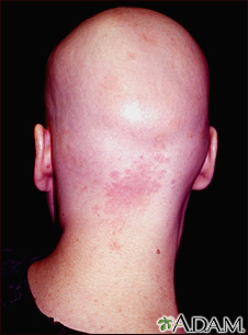 Alopecia total - vista posterior de la cabeza