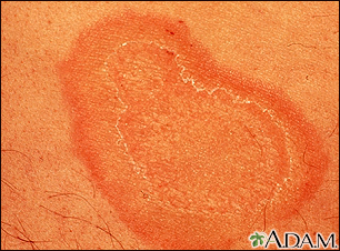 Eritema anular centrífugo - primer plano