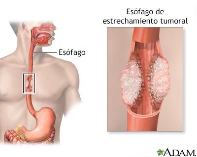 Cáncer esofágico