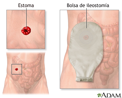 Ileostomía - estoma y bolsa