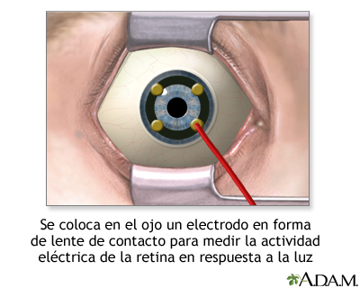 Electrodo de lente de contacto en el ojo