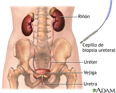 Biopsia ureteral