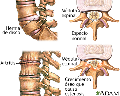 Dolor de espalda - factores de la edad