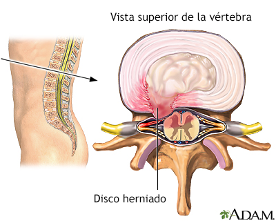 Disco herniado
