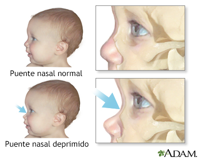 Puente nasal deprimido