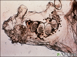 Microfotografía del ácaro de la escabiosis, los huevos y el ácaro en las heces