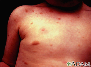 Urticaria pigmentosa en el tórax