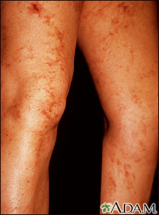 Livedo reticularis en las piernas