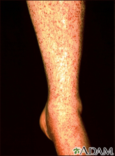 Vasculitis