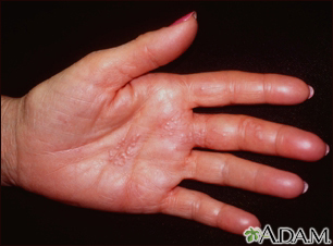 Herpes zoster (culebrilla) en la mano