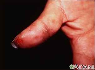 Dermatitis herpetiforme en el pulgar