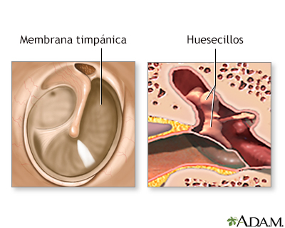 Reparación quirúrgica del tímpano - Serie