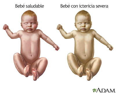 Ictericia infantil - Indicaciones