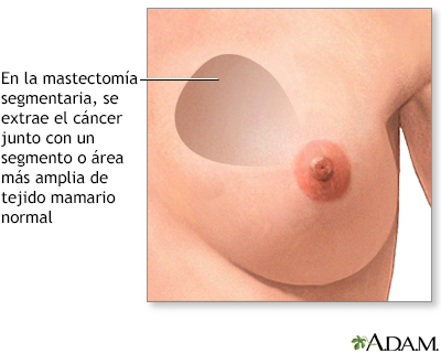 Mastectomía - Procedimiento (primera parte)