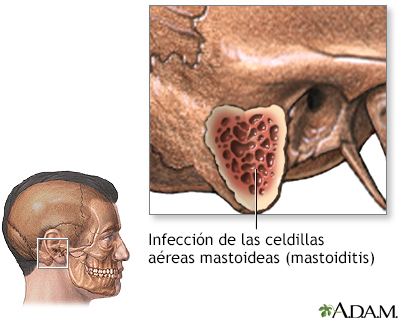 Mastoiditis - Indicaciones