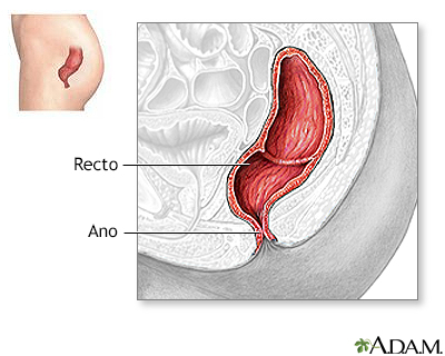 Reparación quirúrgica de prolapso rectal - serie