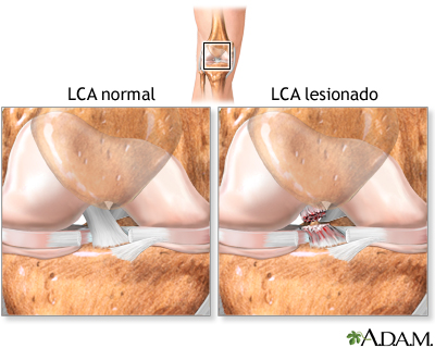 Lesión del ligamento cruzado anterior (LCA)