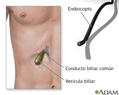 Endoscopia de vesícula biliar