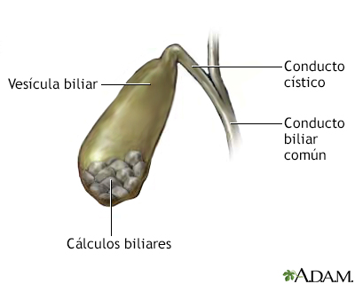 Cálculos biliares