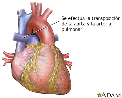 Transposición de los grandes vasos