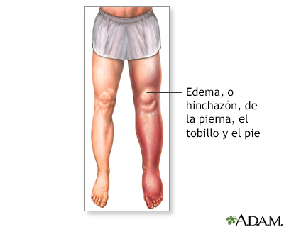 Edema en la parte baja de la pierna