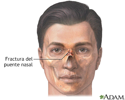 Fractura nasal