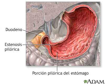 Estenosis pilórica