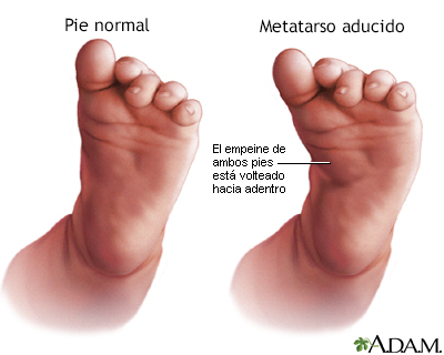 Metatarso aducido