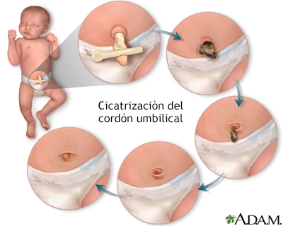 Cicatrización del cordón umbilical