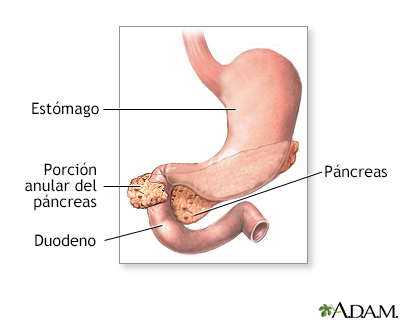 Páncreas anular