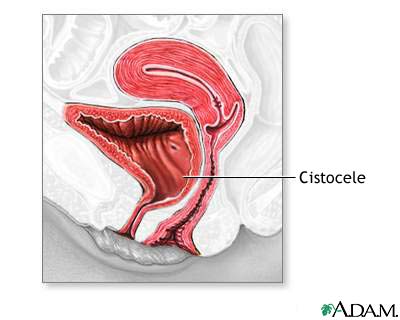 Cistocele