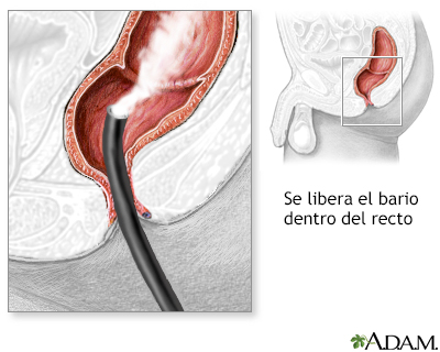 Enema de bario