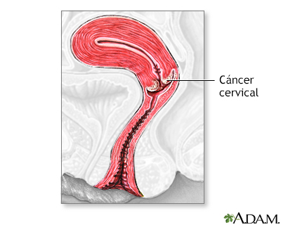 Cáncer cervical