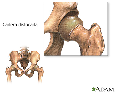 Dislocación congénita de cadera