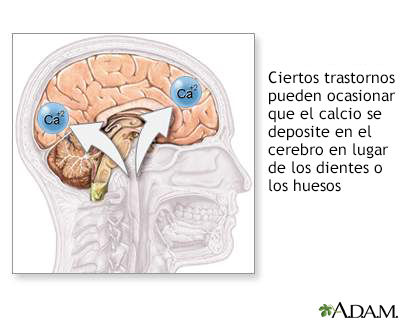 Calcificación craneal