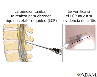 Examen del LCR para sífilis