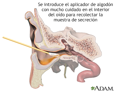 Cultivo del drenaje del oído