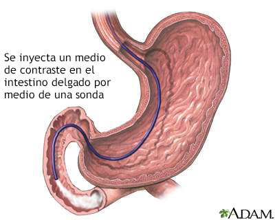 Inyección de contraste en el intestino delgado