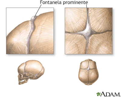 Fontanelas abultadas