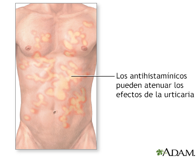 Tratamiento de la urticaria