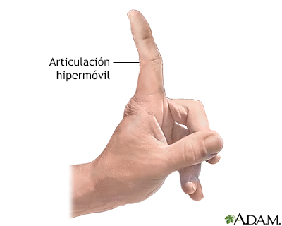 Articulaciones hipermóviles