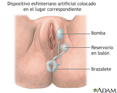 Esfínter artificial inflable